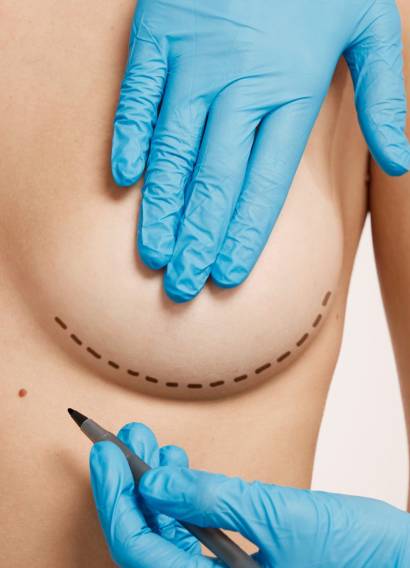 woman-marked-out-cosmetic-surgery-2048×1365 woman-marked-out-cosmetic-surgery-2048x1365
